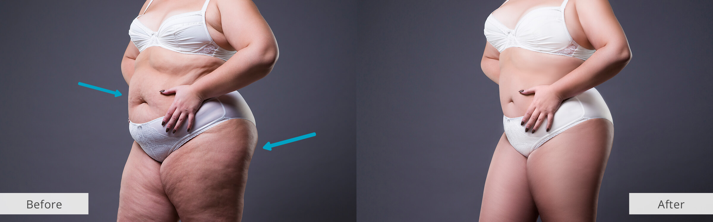 aplicație netedă pentru celulită înainte și după