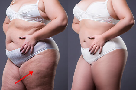 Uklonite celulit u 1 klik