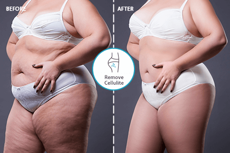 App to Remove Cellulite in Photos Online [FREE]