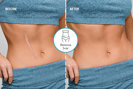 עורך תמונות להסרת צלקות עבור אנדרואיד ו-iOS