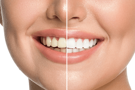 أفضل 11 تطبيق لتبييض الأسنان وتحسين الابتسامة في الصور لعام {{%year}} 