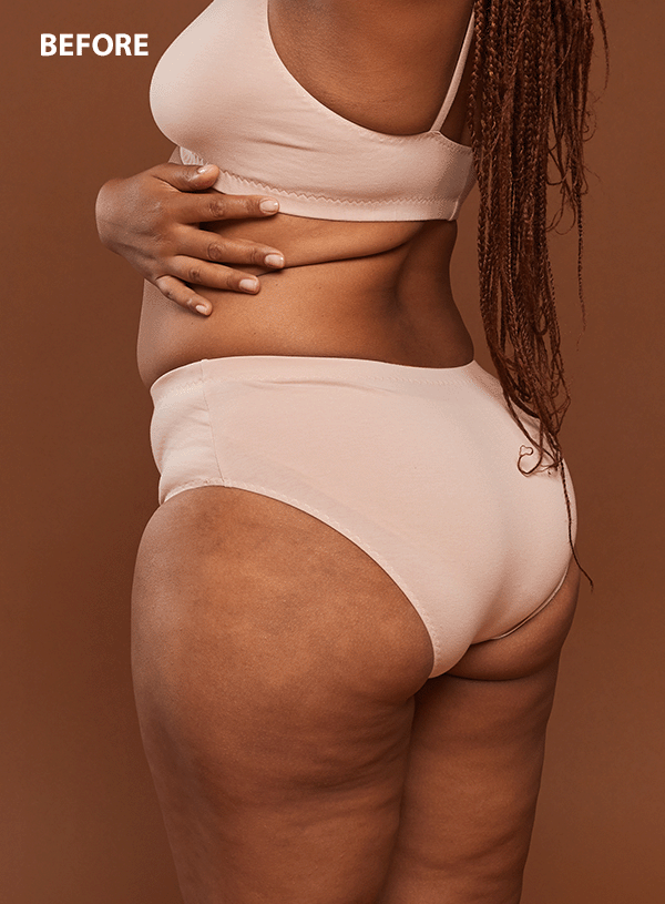 App to Remove Cellulite in Photos Online [FREE]
