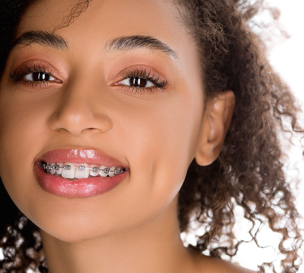 braces filter online