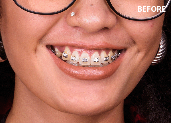 braces remover filter