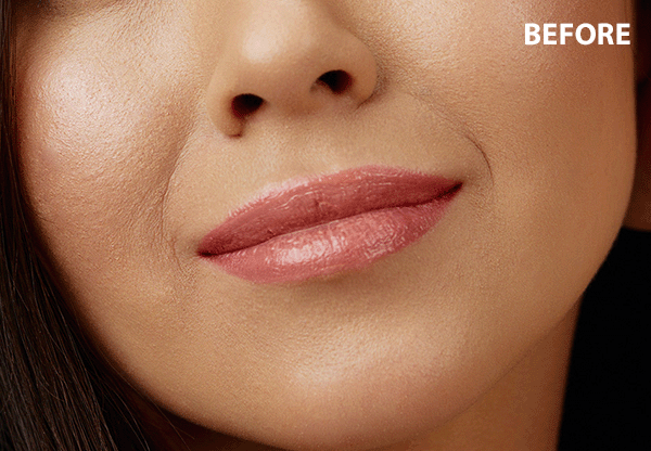 cupids bow lips before after