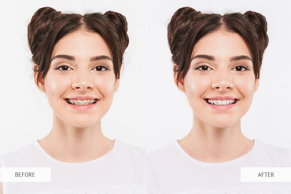 how will i look without braces