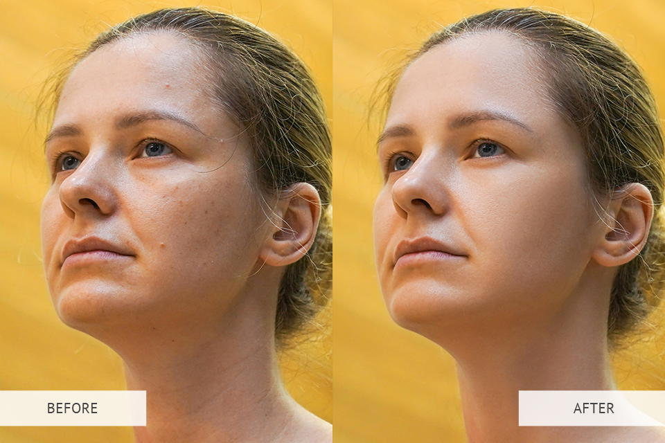 photo editor dark spot remover