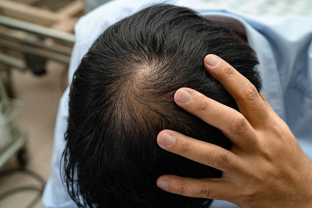 put hair on bald head application