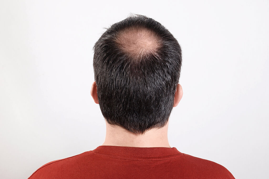 put hair on bald head app