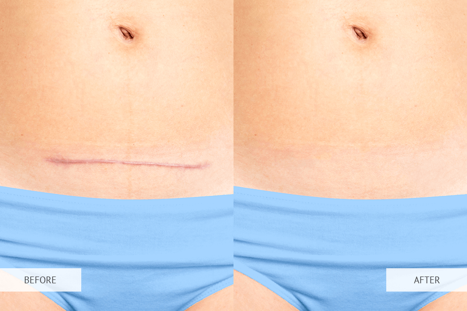 scar removal app before after