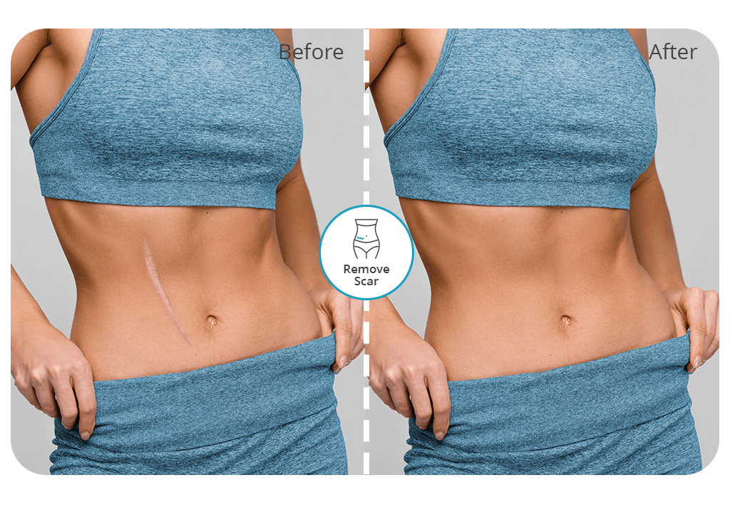 scar removal app cover