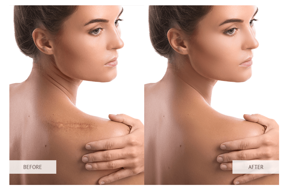 scar removal app