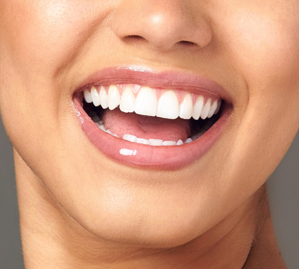 teeth correction app result